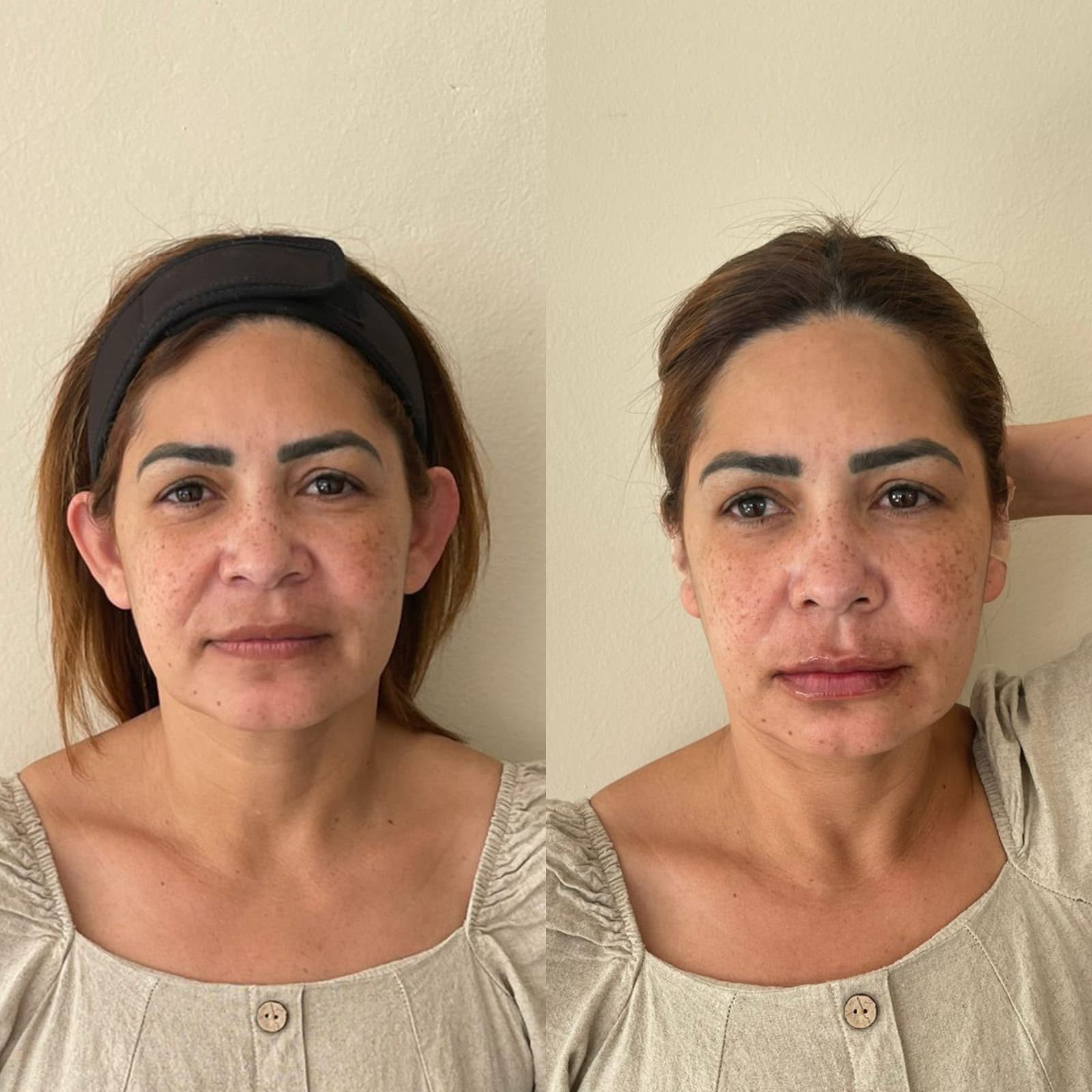 Antes e depois de otomodelação — caso 06
