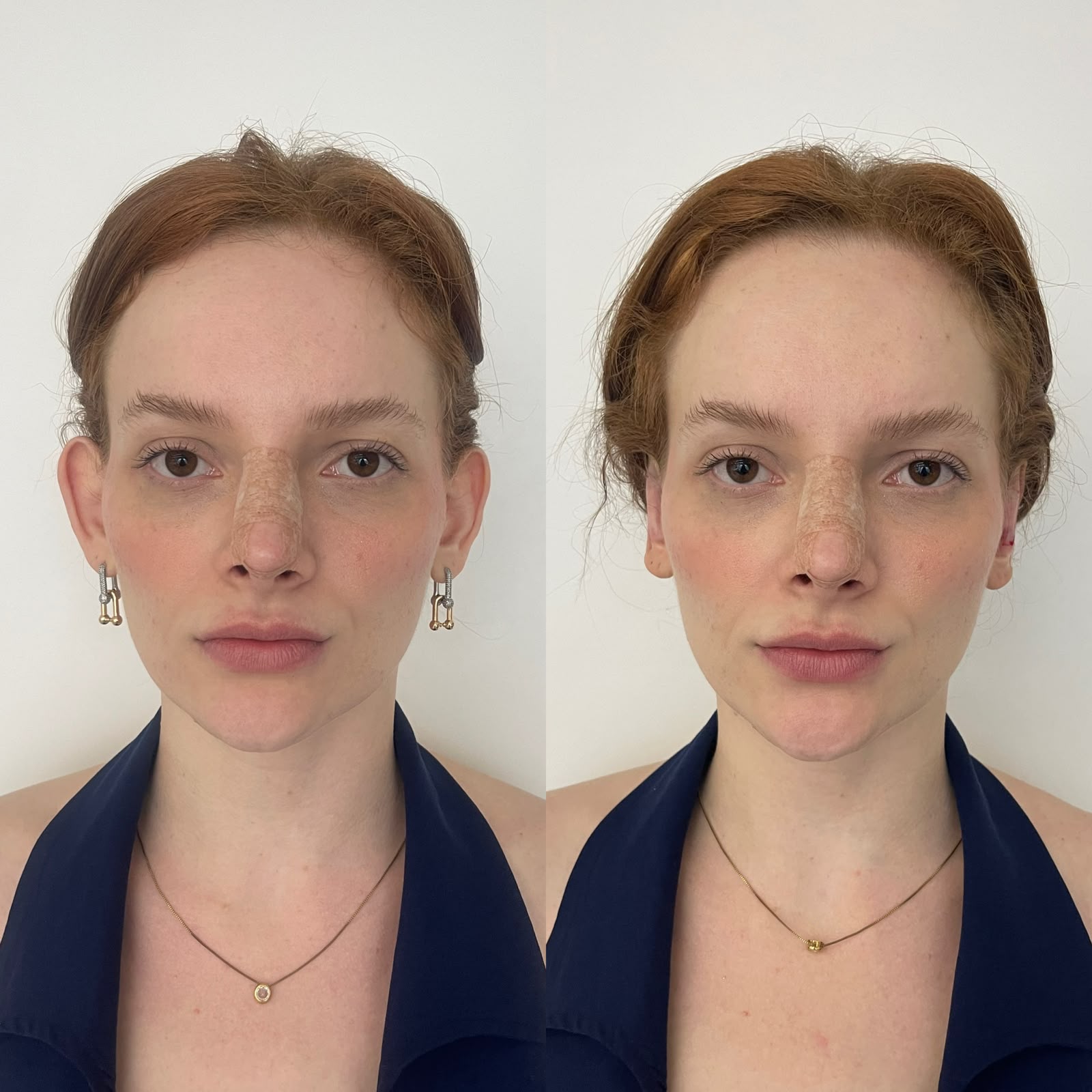 Antes e depois de otomodelação — caso 04