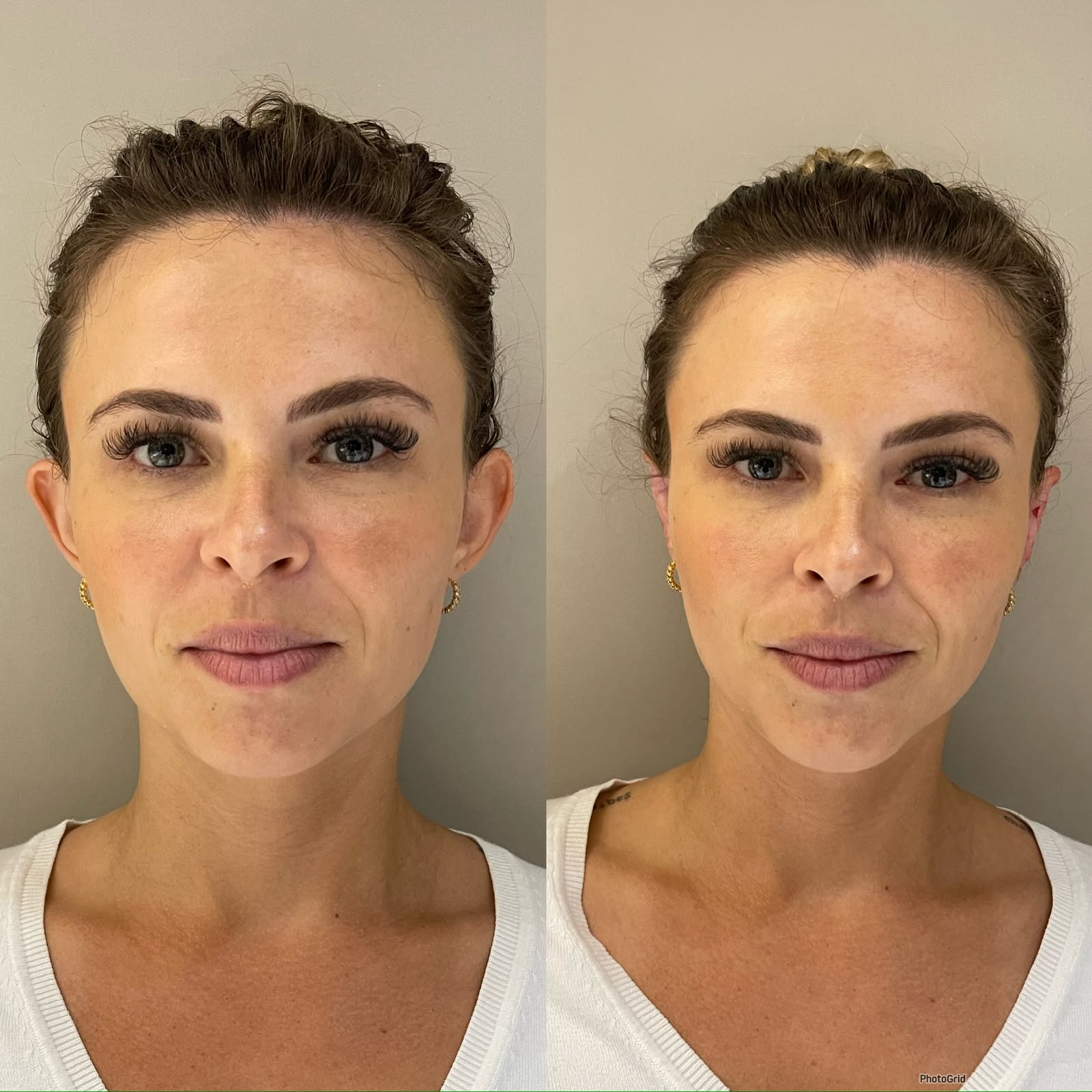 Antes e depois de otomodelação — caso 05