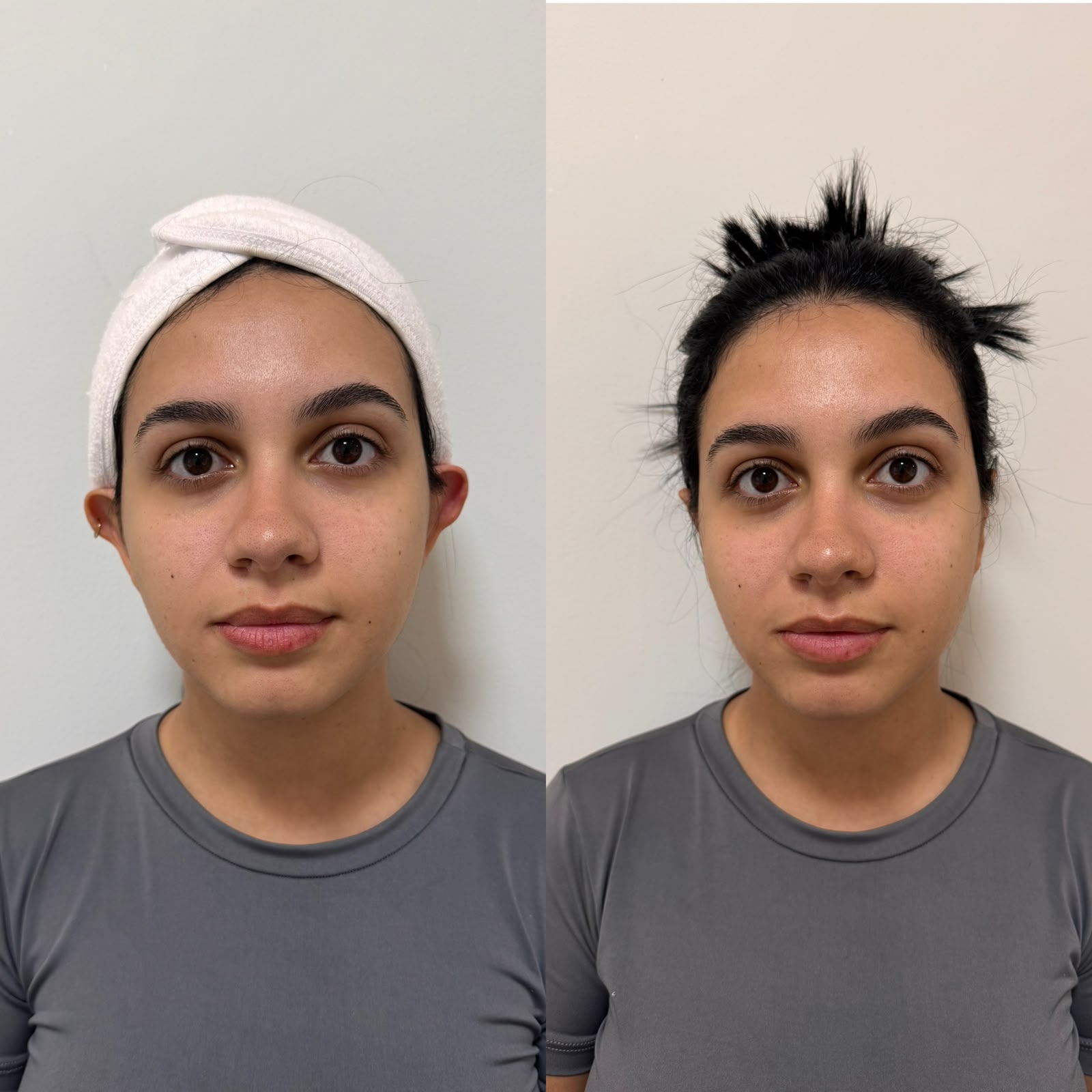 Antes e depois de otomodelação — caso 02